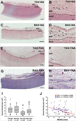 Medial Hypoxia and Adventitial Vasa Vasorum Remodeling in Human Ascending Aortic Aneurysm